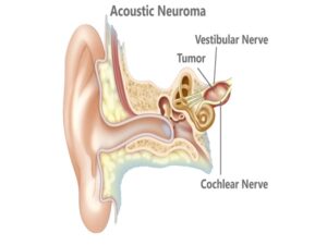 Acoustic Neuroma