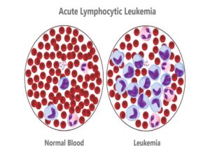 Acute Lymphocytic Leukemia