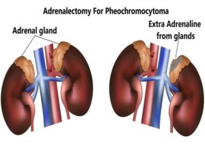 Adrenalectomy For Pheochromocytoma.