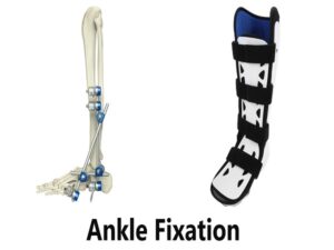 Ankle Fixation 