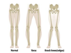 Ankle Valgus Deformity