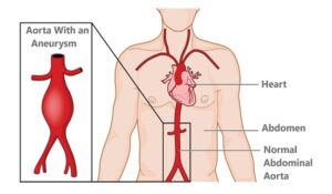 Aortic Aneurysm