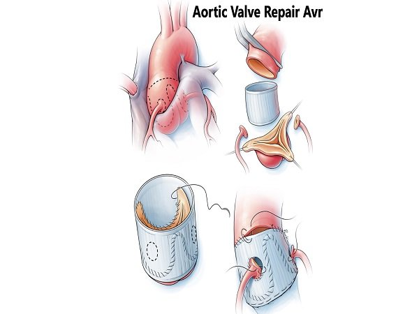 Aortic Valve Repair Avr – Med Consult India