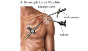 Arthroscopic Loose Shoulder