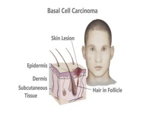Basal Cell Carcinoma