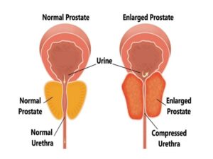 Benign Prostatic Hyperplasia