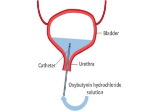 Bladder Instillation