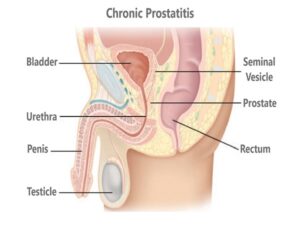 Chronic Prostatitis
