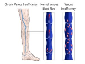 Chronic Venous Insufficiency