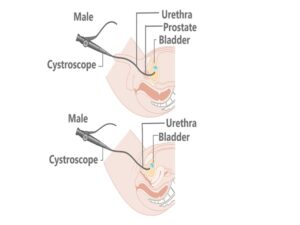 Cystoscopy