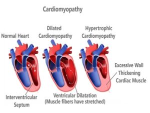 cardiomyopathy