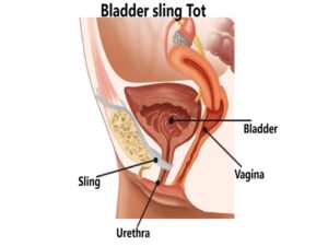 Bladder sling tot