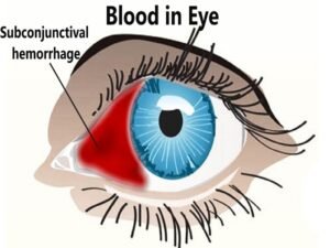 Blood in eye