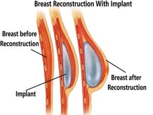 Breast Reconstruction With Implant