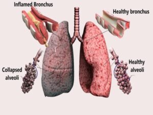 Chronic Obstructive Pulmonary Disease