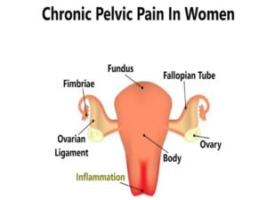 Chronic Pelvic Pain In Women