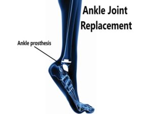 ankle joint replacement