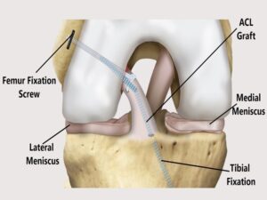 ACl reconatruction surgery