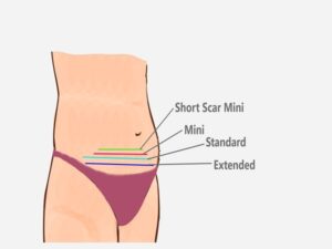 Abdominoplasty Cost in India