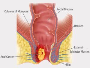 Anal Cancer Treatment