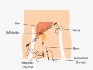 Cholecystectomy Surgery Cost in India