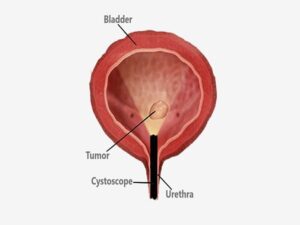 Transurethral Resection Of Bladder Tumor Turbt in India